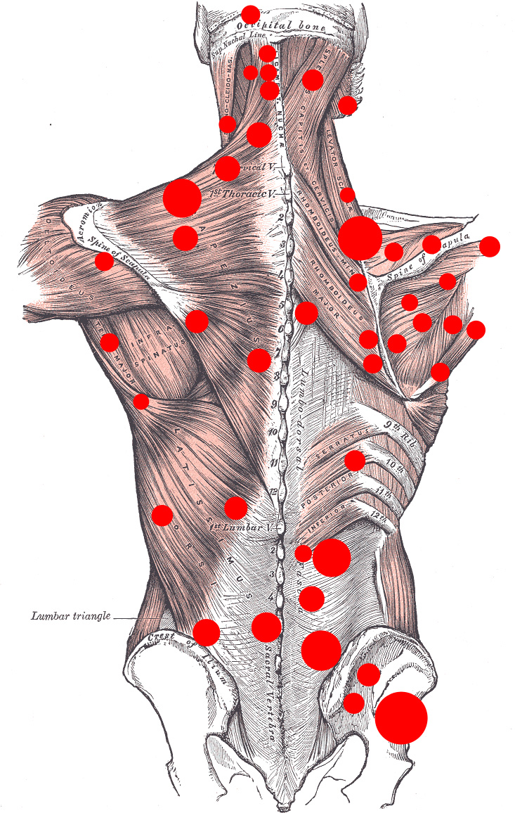 What is myofascial pain syndrome?